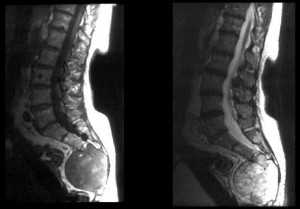 Хордома крестца