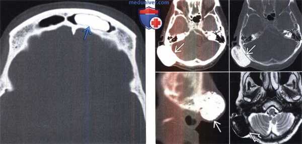 Доброкачественная мезенхимальная опухоль на КТ, МРТ головы