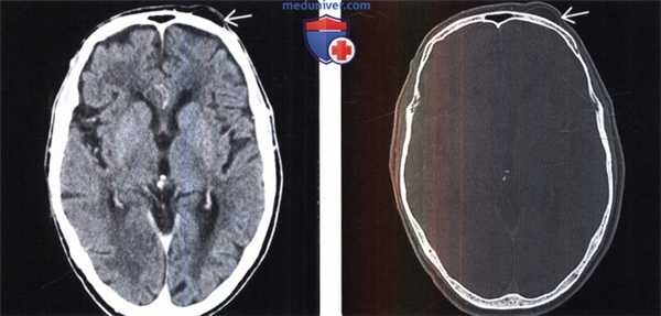 Доброкачественная мезенхимальная опухоль на КТ, МРТ головы