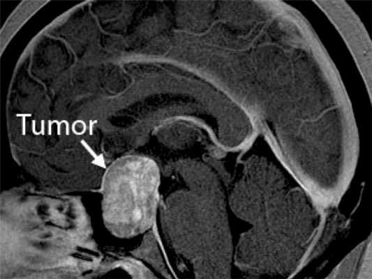 Аденома гипофиза