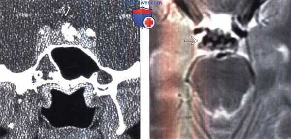 Доброкачественная мезенхимальная опухоль на КТ, МРТ головы