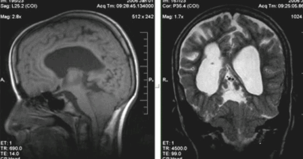 Аномалия Арнольда-Киари (II) на снимке МРТ
