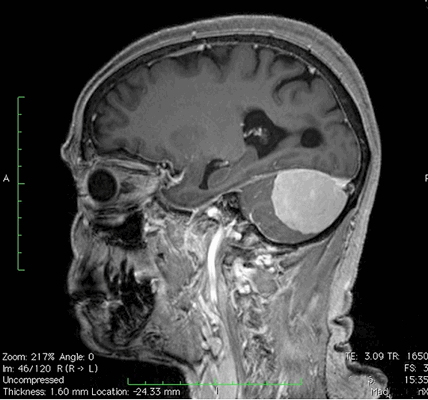 МРТ мозжечка, что показывает
