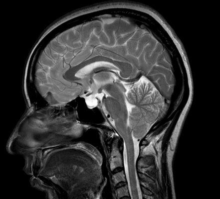 Синдром Арнольда-Киари