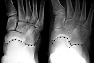 Таранно-ладьевидная линия