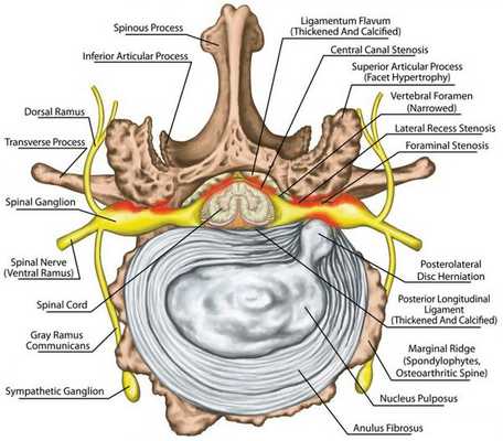 Спинальный стеноз