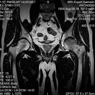 МРТ тазобедренного сустава