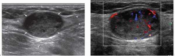 На снимке образование, подозрительное на фибросаркому