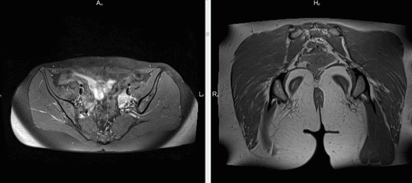 Магнитно-резонансная томография тазового пояса