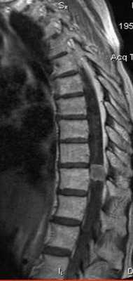 Менингиома грудного отдела позвоночника