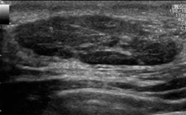 На сонограмме видна фибролипома