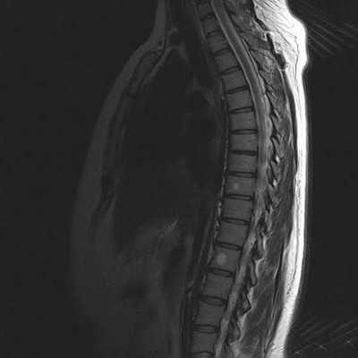 Гемангиомы на МРТ