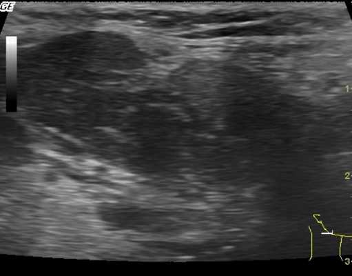 Межмышечная гематома