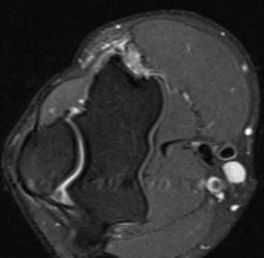 МРТ локтевого сустава в аксиальной плоскости