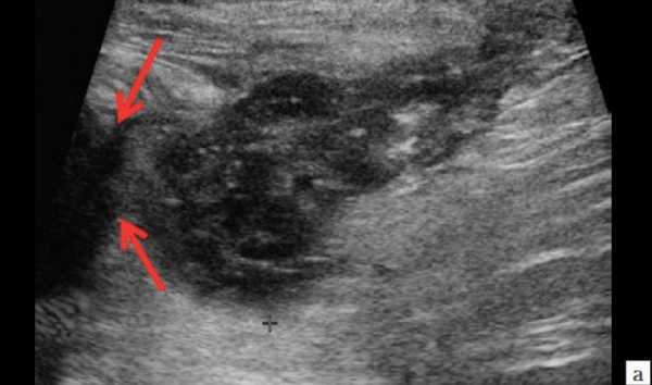  Ультразвуковое исследование перианальной области. На сонограмме образование с жидкостным содержимым - УЗ-картина парапроктита