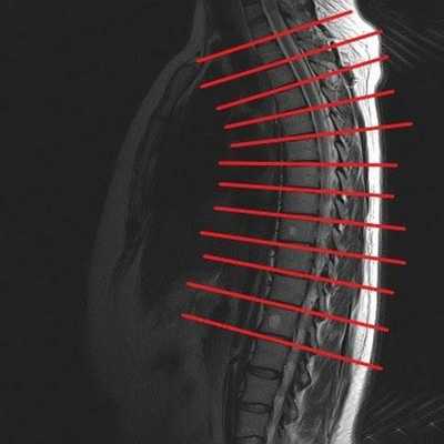 МРТ грудного отдела 