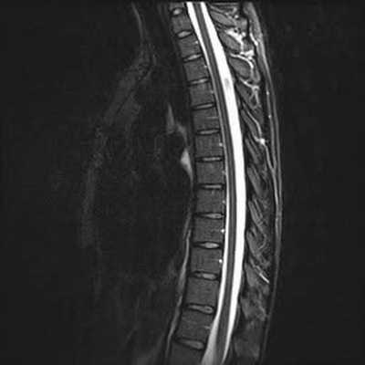 Снижение высоты межпозвонковых дисков грудного отдела на снимке МРТ