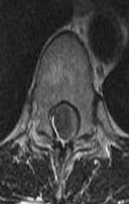 Менингиома на МРТ грудного отдела позвоночника