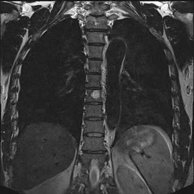 Гемангиома на МРТ грудного отдела позвоночника