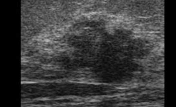 УЗИ мягких тканей что показывает