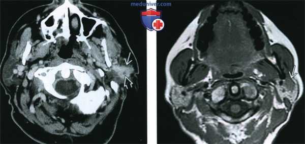 КТ, МРТ при мукоэпидермоидном раке околоушной железы