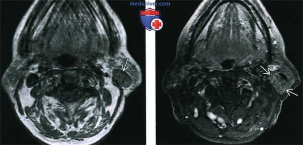 КТ, МРТ при мукоэпидермоидном раке околоушной железы