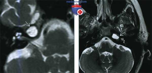 Мукоцеле вершины пирамиды височной кости - лучевая диагностика