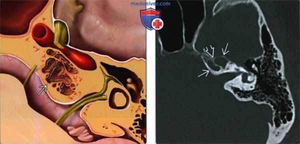 Запертая жидкость в вершине пирамиды височной кости - лучевая диагностика