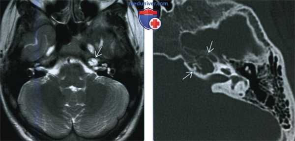 Запертая жидкость в вершине пирамиды височной кости - лучевая диагностика