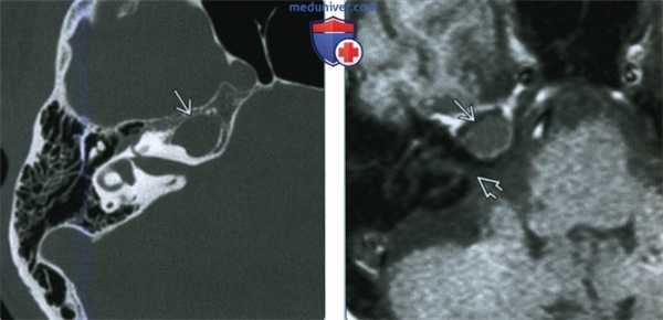 Мукоцеле вершины пирамиды височной кости - лучевая диагностика