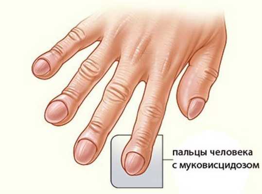 Муковисцидоз легких