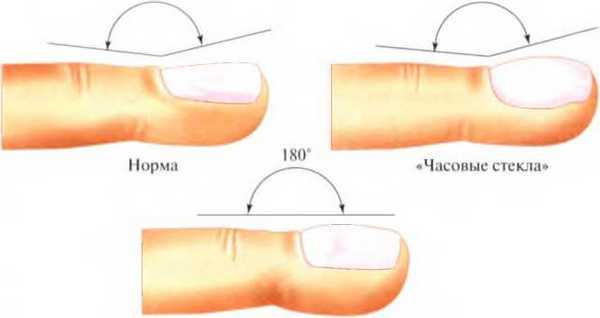 Муковисцидоз легких