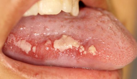 Псевдомембрана на язве [26]