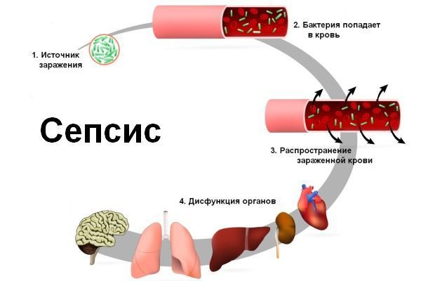 Сепсис