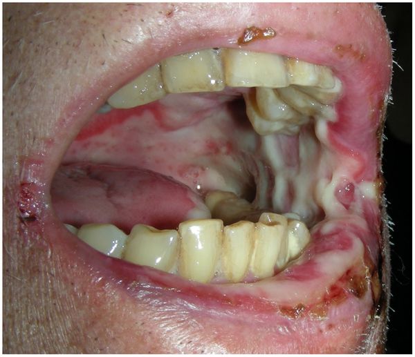 Тяжёлая степень мукозита [24]