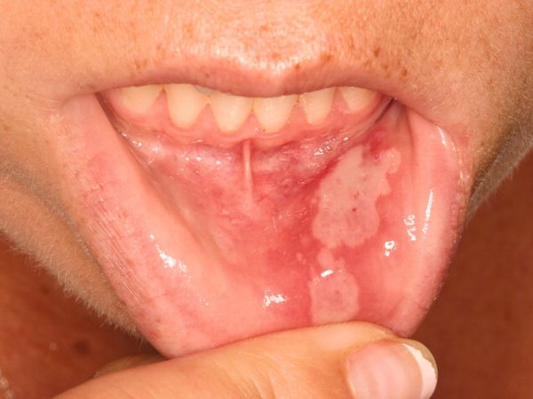 Язва в полости рта [25]