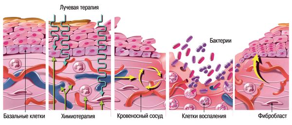 Развитие мукозита