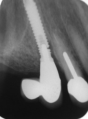 Перелом имплантата [24]