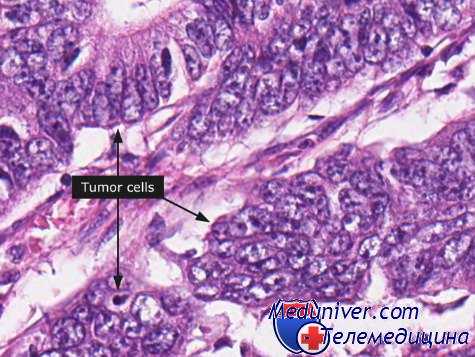 множественные опухоли