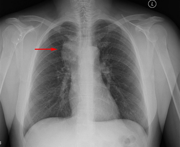 Первично-множественные опухоли