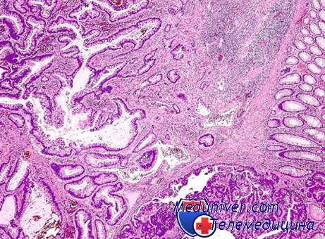 мультицентричные множественные опухоли
