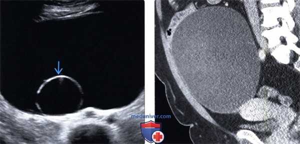 Методы обследования муцинозной цистаденомы и рака яичника