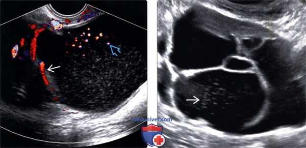 Методы обследования муцинозной цистаденомы и рака яичника