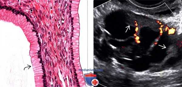 Методы обследования муцинозной цистаденомы и рака яичника