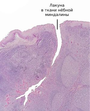 Лакуна в ткани нёбной миндалины [11]