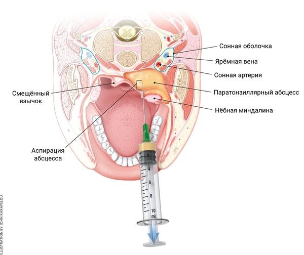 Аспирация абсцесса