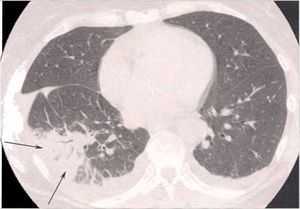 rn легких с пневмонией