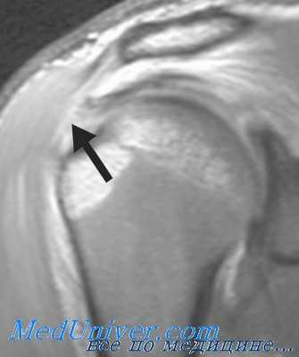 поддельтовидный бурсит