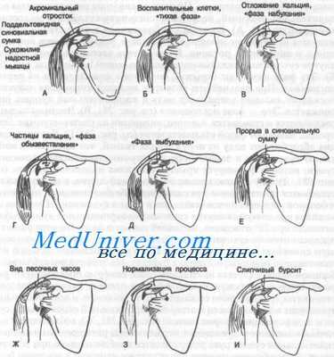 поддельтовидный бурсит