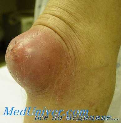 бурсит локтевого сустава